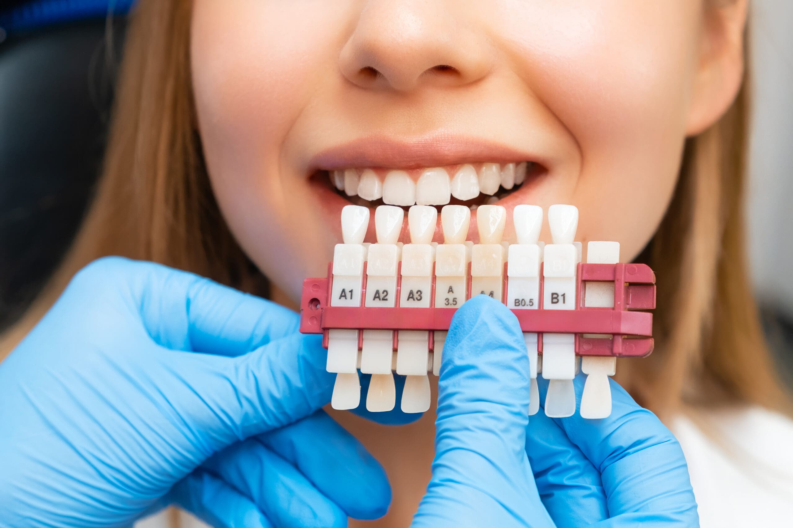 Porcelain Veneers Winter Springs, FL