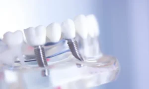 What to Know About Dental Implants in Winter Springs, FL