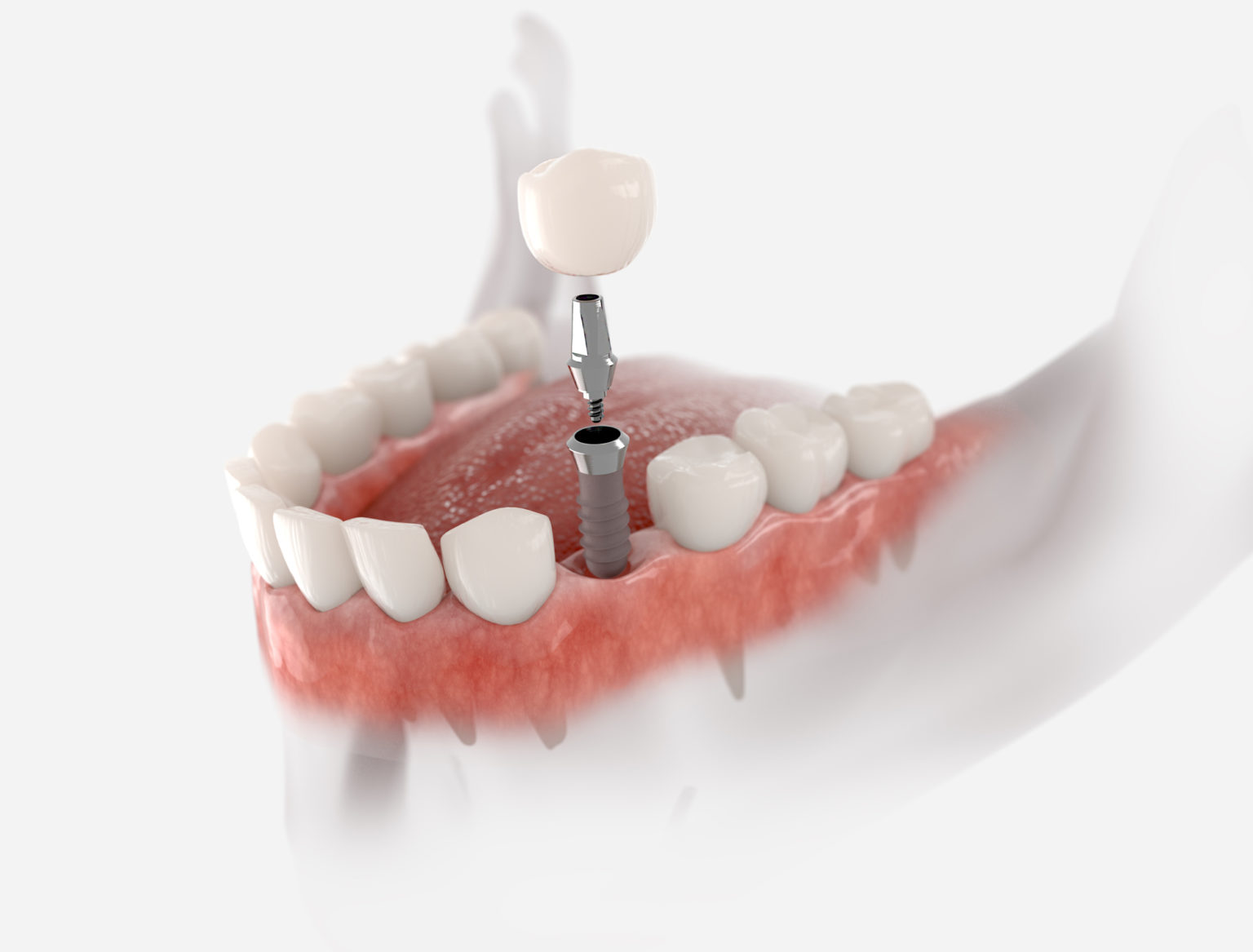 How Much Do Dental Implants Cost in Winter Springs, FL