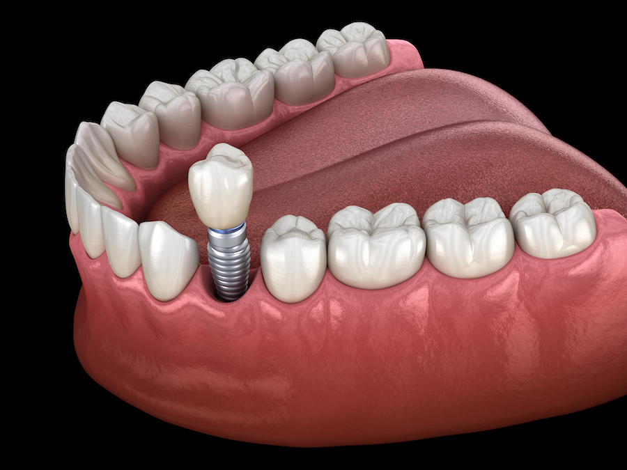 What to Expect During Your Dental Implant Consultation in Winter Springs, FL