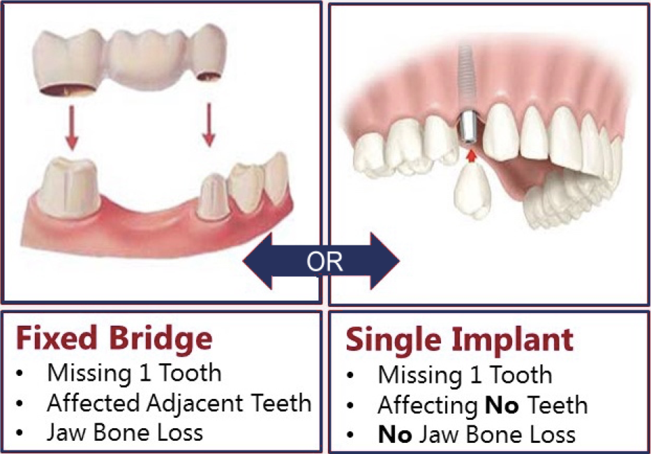 Single Dental Implants vs Dental Bridges